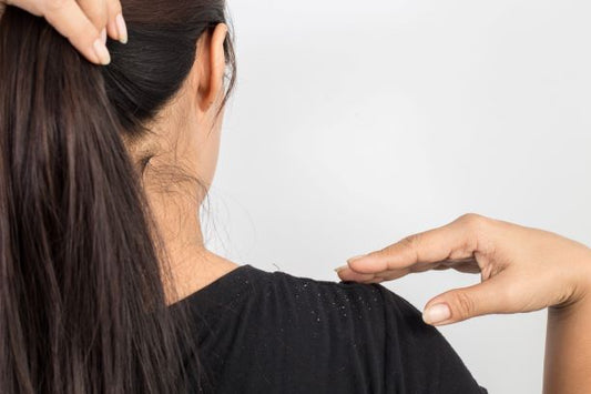 Why You’re Still Getting Dandruff – And What Ayurveda Says About It