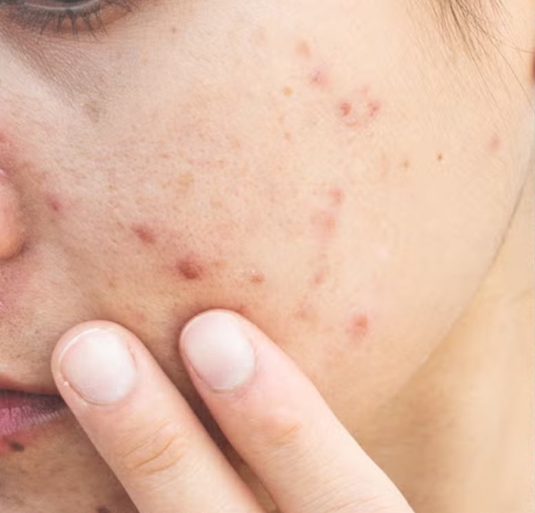 Acne/Pimples