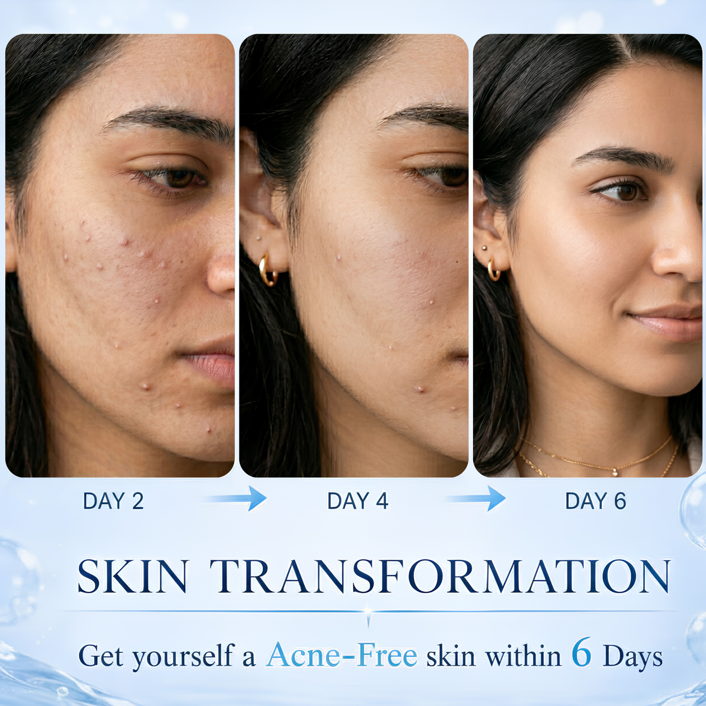 Acne Goat Milk Soap for Acne-Prone Skin with Lodh & Manjistha