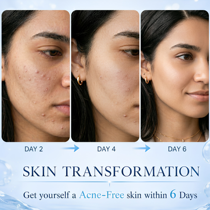 Acne Goat Milk Soap for Acne-Prone Skin with Lodh & Manjistha